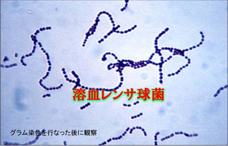 A型溶血レンサ球菌